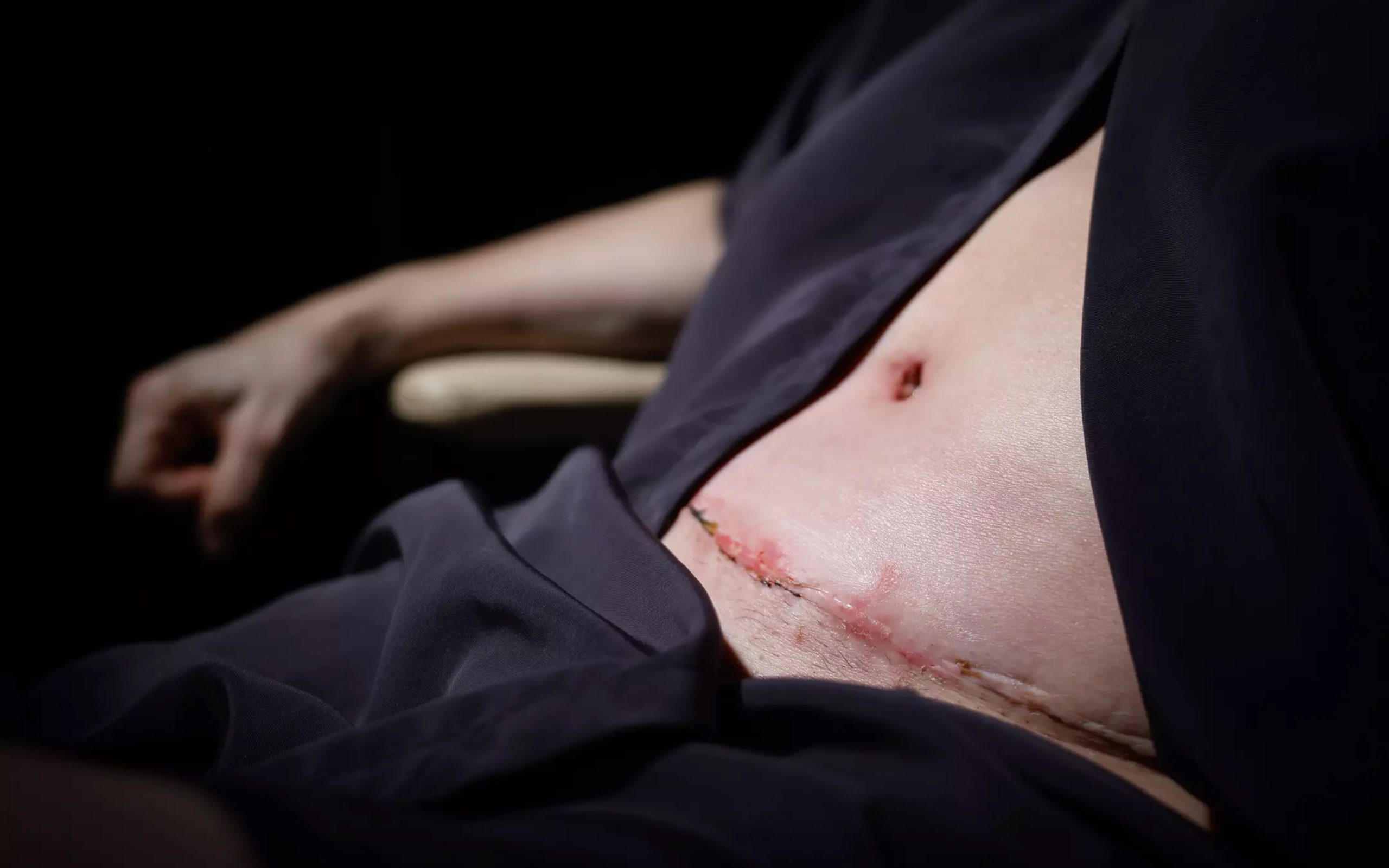 Jennifer’s post-surgery scar about three weeks after her tummy tuck....